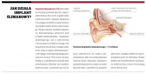 JAK DZIAŁA IMPLANT ŚLIMAKOWY?