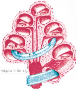 Przekrój ślimaka. Ułożenie elektrod zależy od anatomii ucha wewnętrznego. U każdego pacjenta może być ono nieco inne.